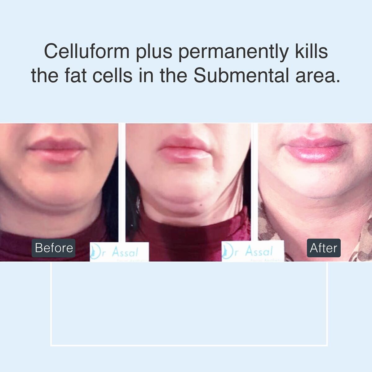 Amazing results by @drassal.co.uk with Celluform Plus. 💕 #celluform #celluformplus #deoxycholicacid #drassal #amedicauk www.celluform.co.uk